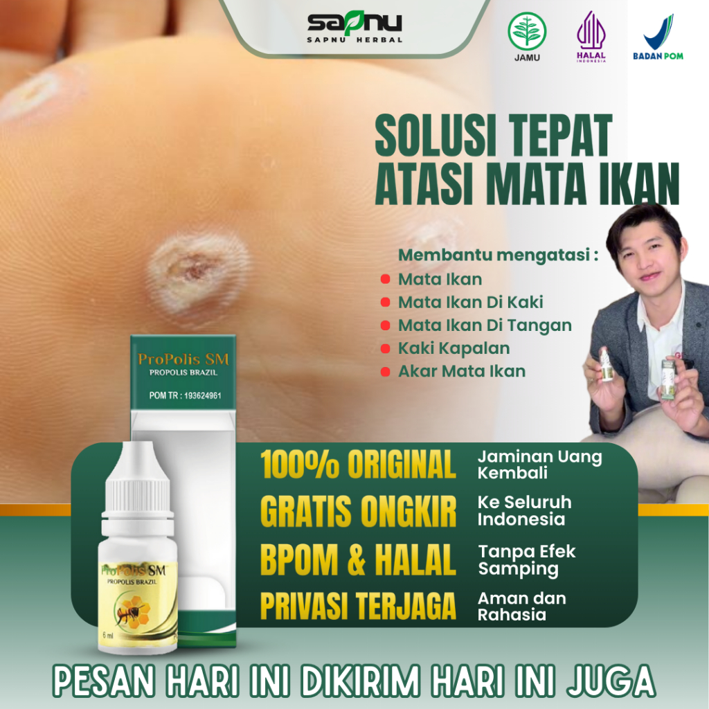 Propolis SM Obat Mata Ikan Pada Telapak Kaki, Obat Penghilang Mata Ikan di Telapak Kaki / Tangan, Ob