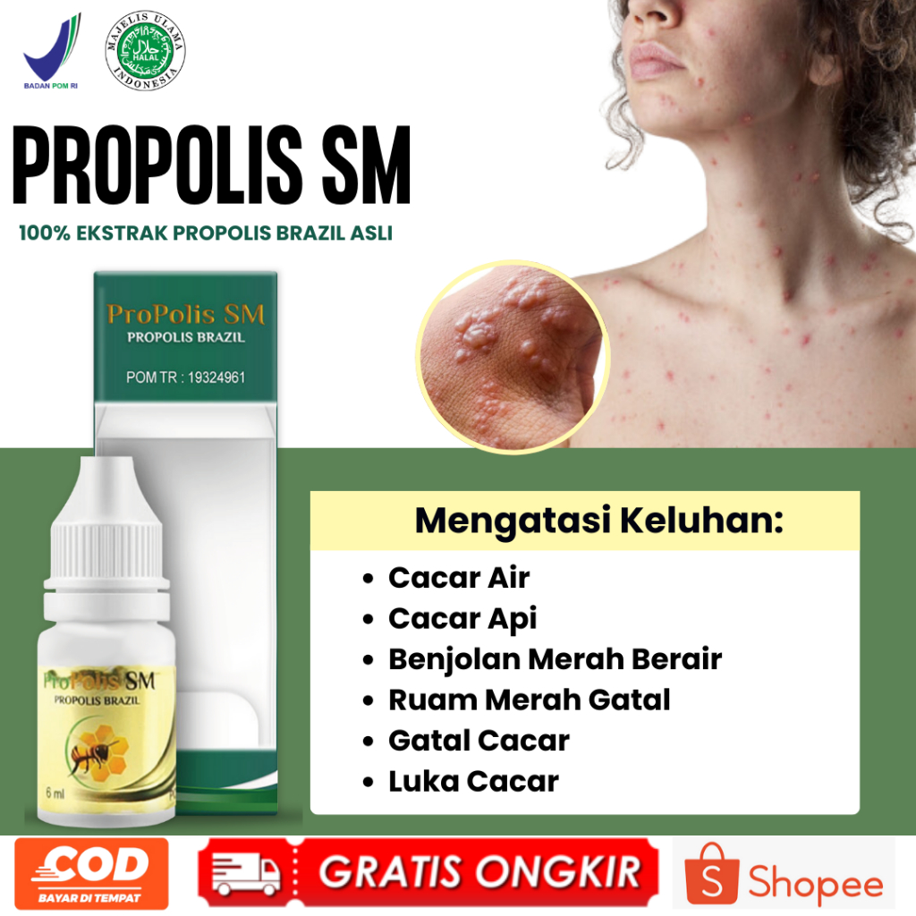 Obat Cacar Benjolan Merah Berair Penghilang Bekas Cacar Campak Cacar Api Cacar Air Anak Cacar Air De