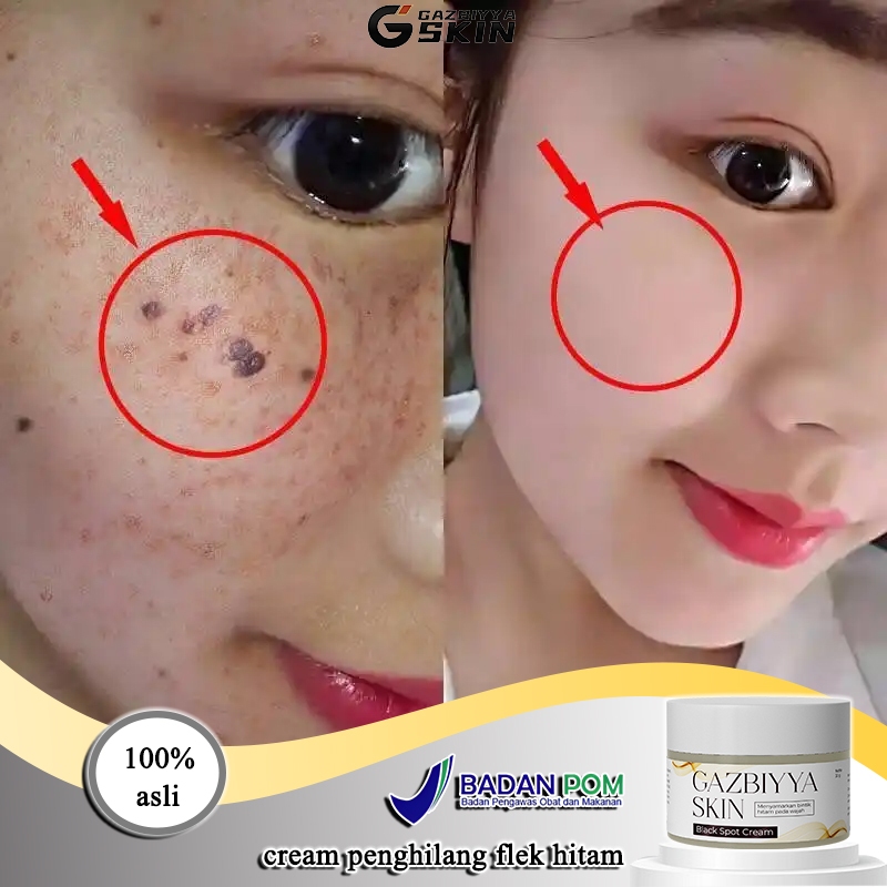 Menghilangkan flek hitam di wajah cream flek hitam membandel cream penghilang flek hitam 30g flek cr
