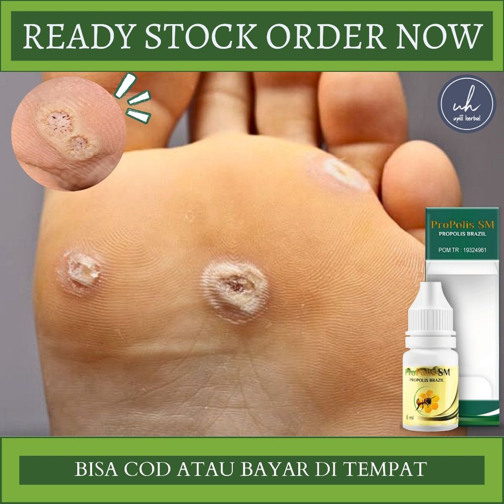 Obat Mata Ikan Pada Telapak Kaki, Obat Perontok Mata Ikan di Telapak Kaki & Tangan, Penghilang Mata 