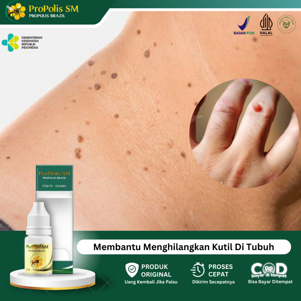 Obat Penghilang Kutil, Obat Penghilang Kutil Di Tangan, Obat Papiloma, Obat Perontok Kutil, Obat Kut