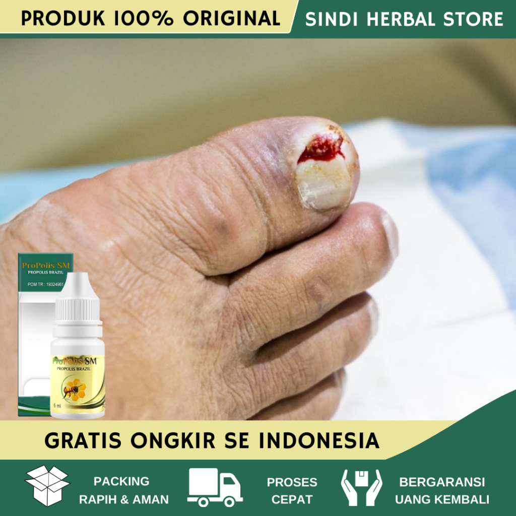 Obat Cantengan Jempol Kaki, Obat Cantengan Parah, Obat Cantengan Jempol Kaki Bengkak Dan Bernanah, O