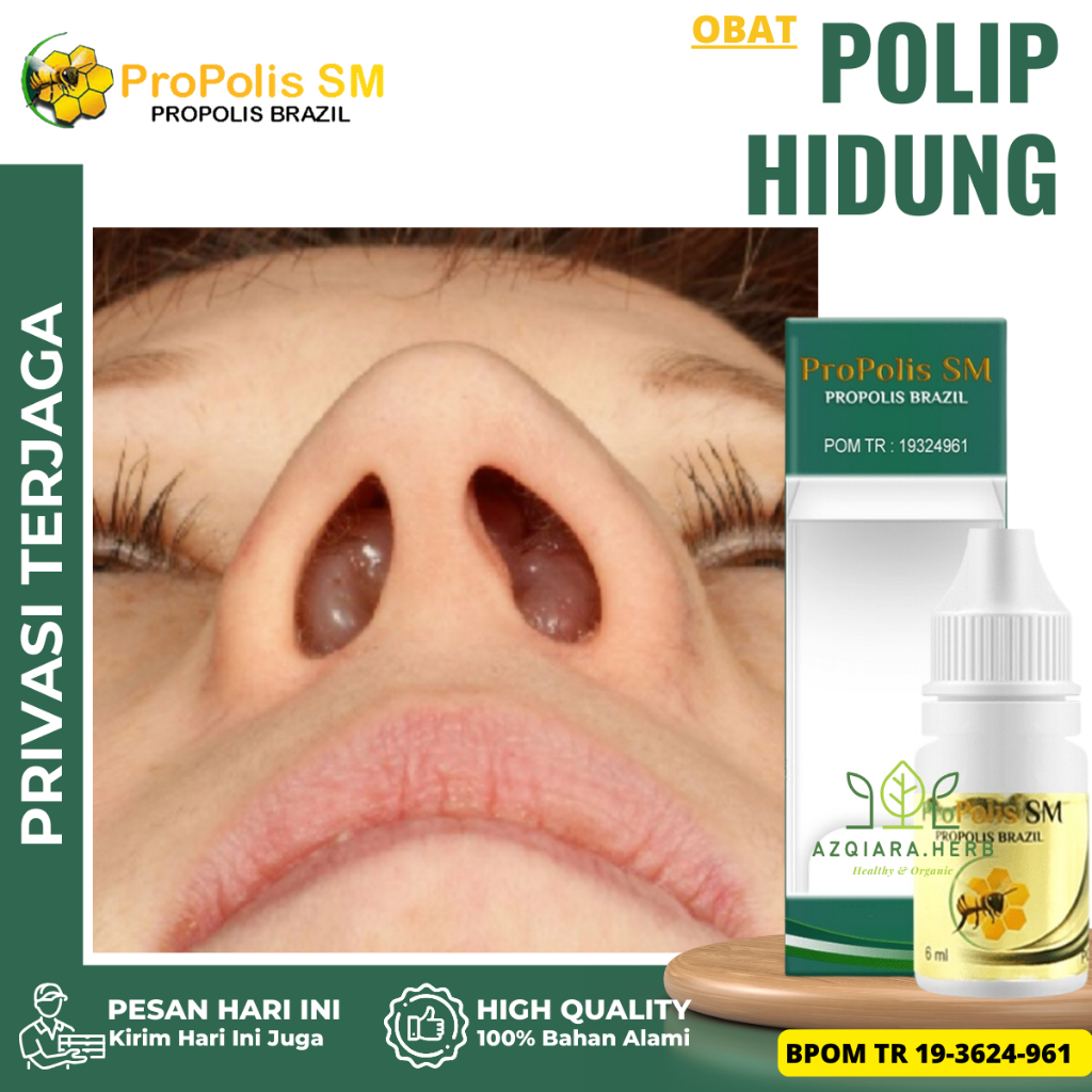 Obat Polip Hidung, Obat Sinusitis Menahun, Obat Polip Hidung Anak Dewasa, Obat Hidung Tersumbat, Oba