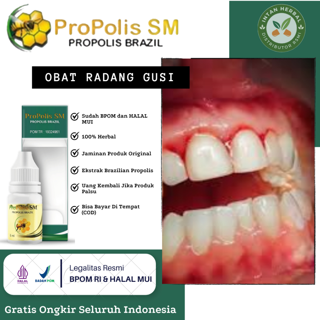 Obat Radang Gusi, Gusi Bengkak, Gusi Turun, Gusi Bernanah, Gusi Sakit, Gusi Berdarah, Abses Gigi, Be
