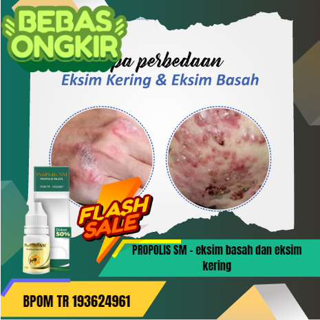 PROPOLIS SM - salep untuk eksim basah, obat eksim basah di apotik, obat eksim kering, obat eksim bas