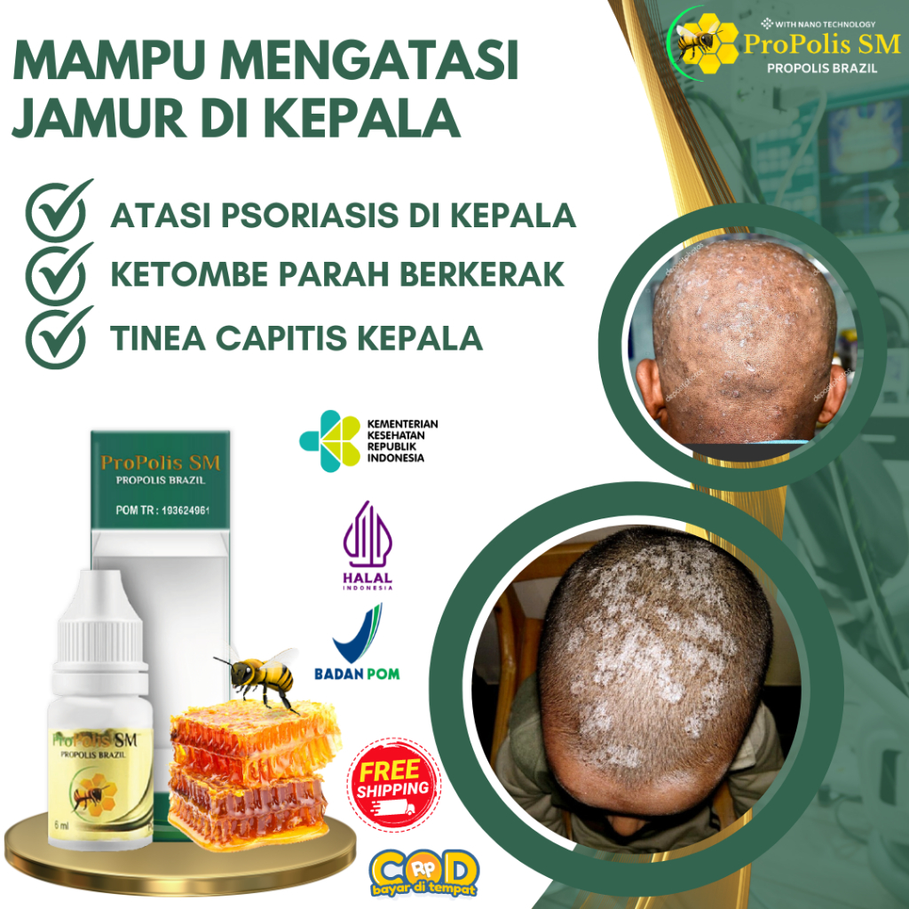 Obat Jamur Kulit Kepala, Tinea Kapitis, Kurap Di Kepala, Obat Tinea Kapitis Jamur Di Kepala, Obat Ja