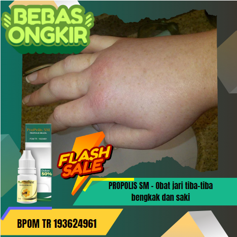 PROPOLIS SM Obat tangan bengkak tiba-tiba, jari tiba-tiba bengkak dan sakit, obat tangan bengkak dan