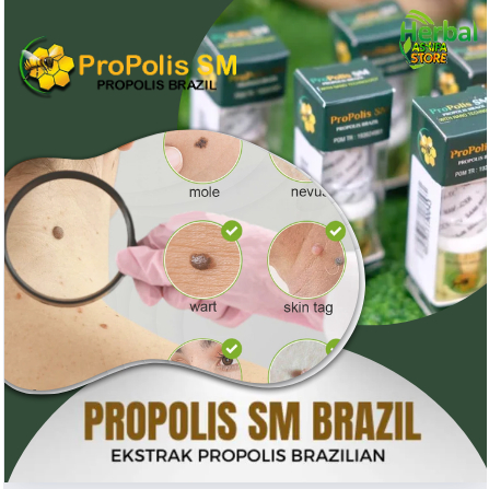 Obat Kutil di Oles Penghilang Kutil di Wajah, Salep Perontok Kutil di Kelopak Mata - Kutilan di Kela