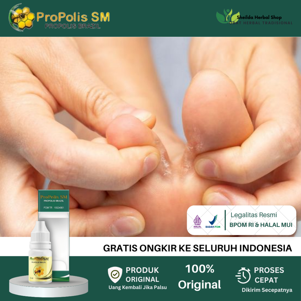 Obat Kutu Air Pada Kaki, Jamur Kutu Air, Kutu Air Pada Sela Jari Kaki, Penghilang Kutu Air Di Kaki d