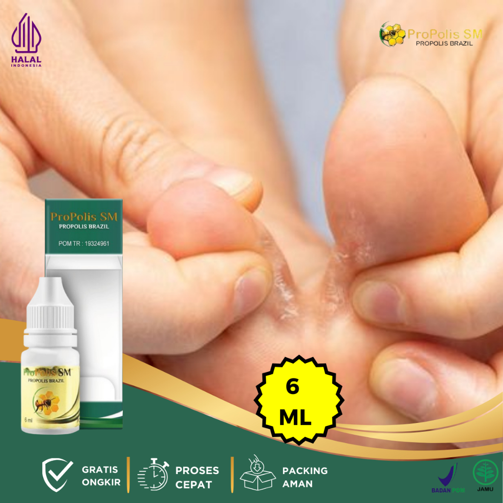 Obat Kutu Air Untuk Kaki, Obat Kutu Air Gatal Di Sela-Sela Jari, Obat Kutu Air Pada Kaki, Obat Pengh