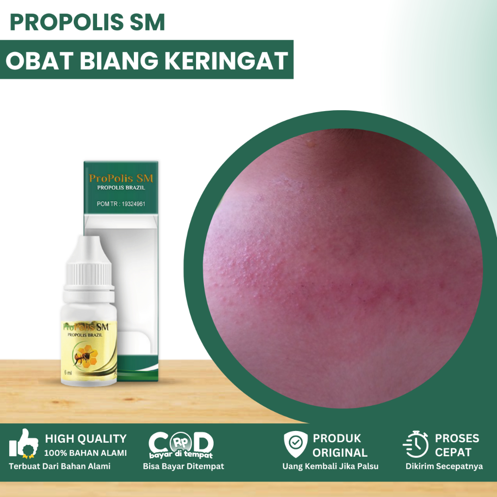 Obat Biang Keringat, Obat Biang Keringat Seluruh Badan, Obat Biang Keringat Di Leher, Gatal Biang Ke