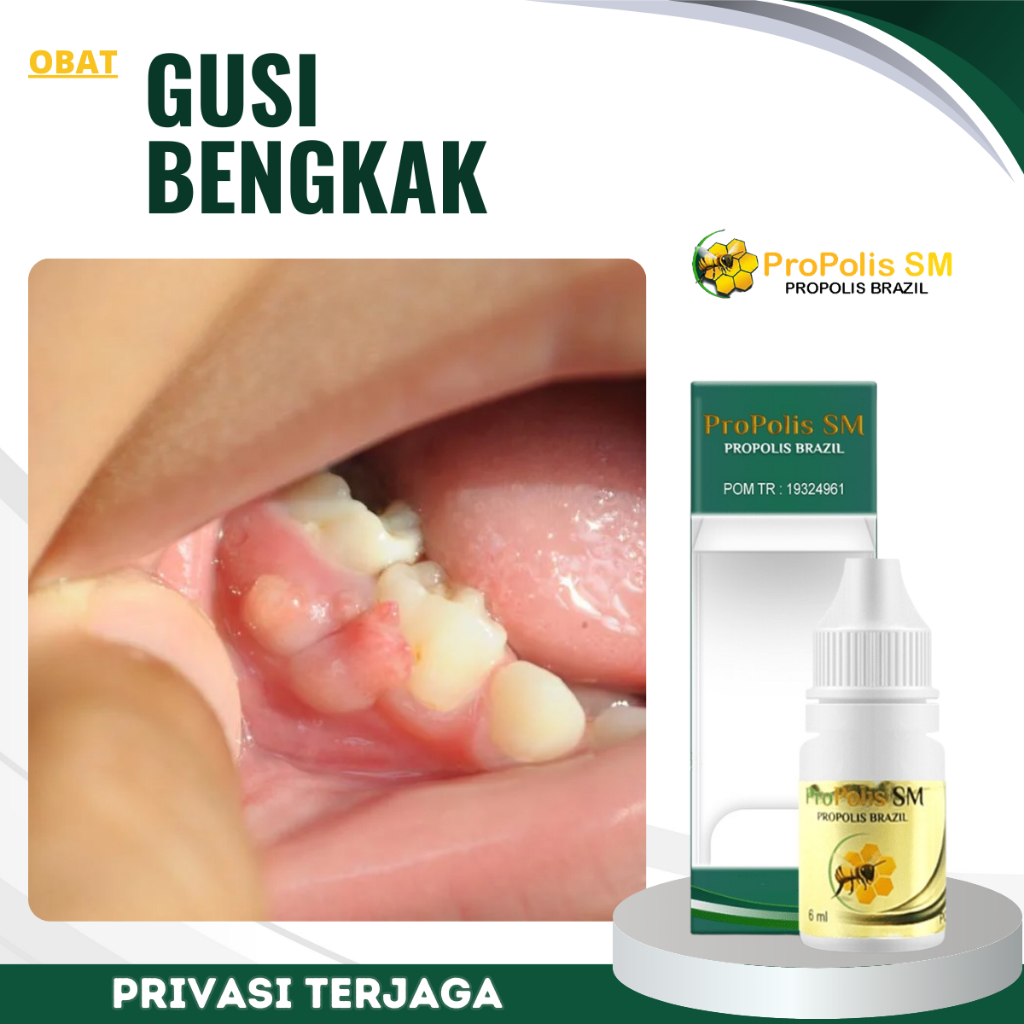 Obat Gusi Bengkak, Obat Abses Gigi Gusi Bernanah, Obat Sakit Gigi Berlubang, Obat Gusi Bernanah, Oba