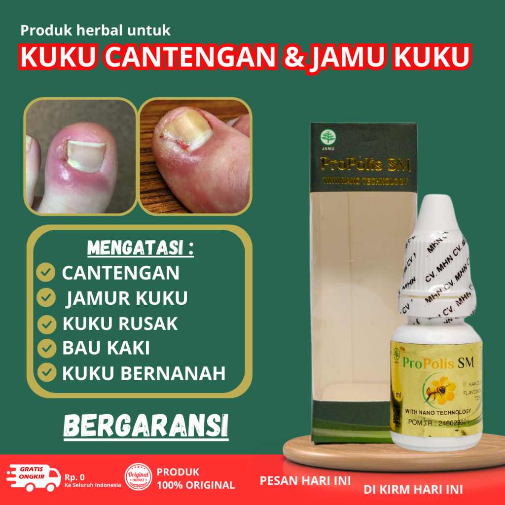 Obat Kuku Cantengan, Cantengan Jempol kaki, kuku Kaki Cantengan, Tetes Kuku Bengkak Bernanah Bau