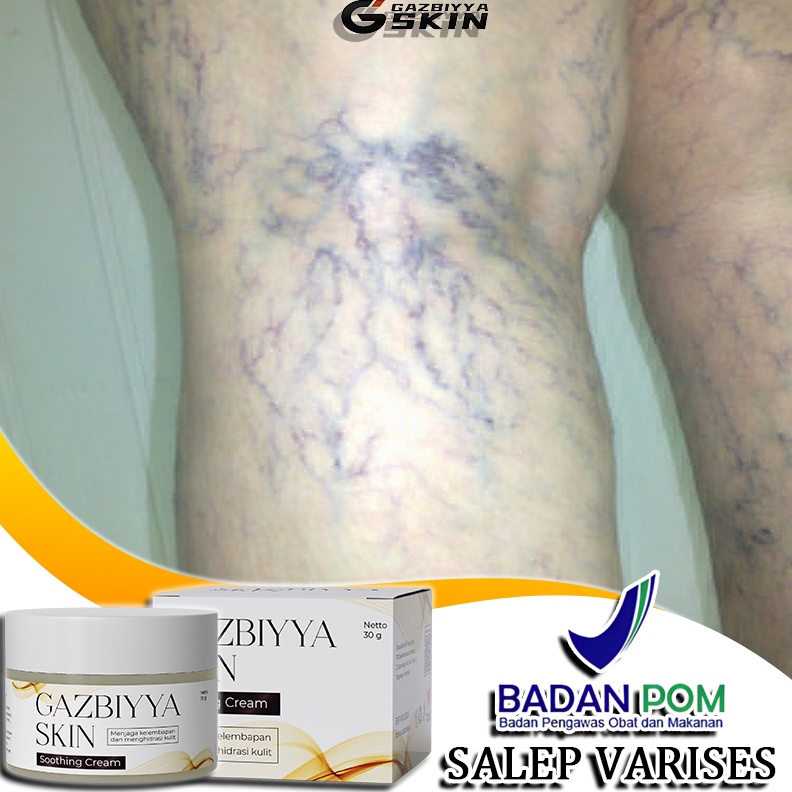 KODE M46A Cream varises paling ampuh original salep varises obat varises salep 3g varises salep laba