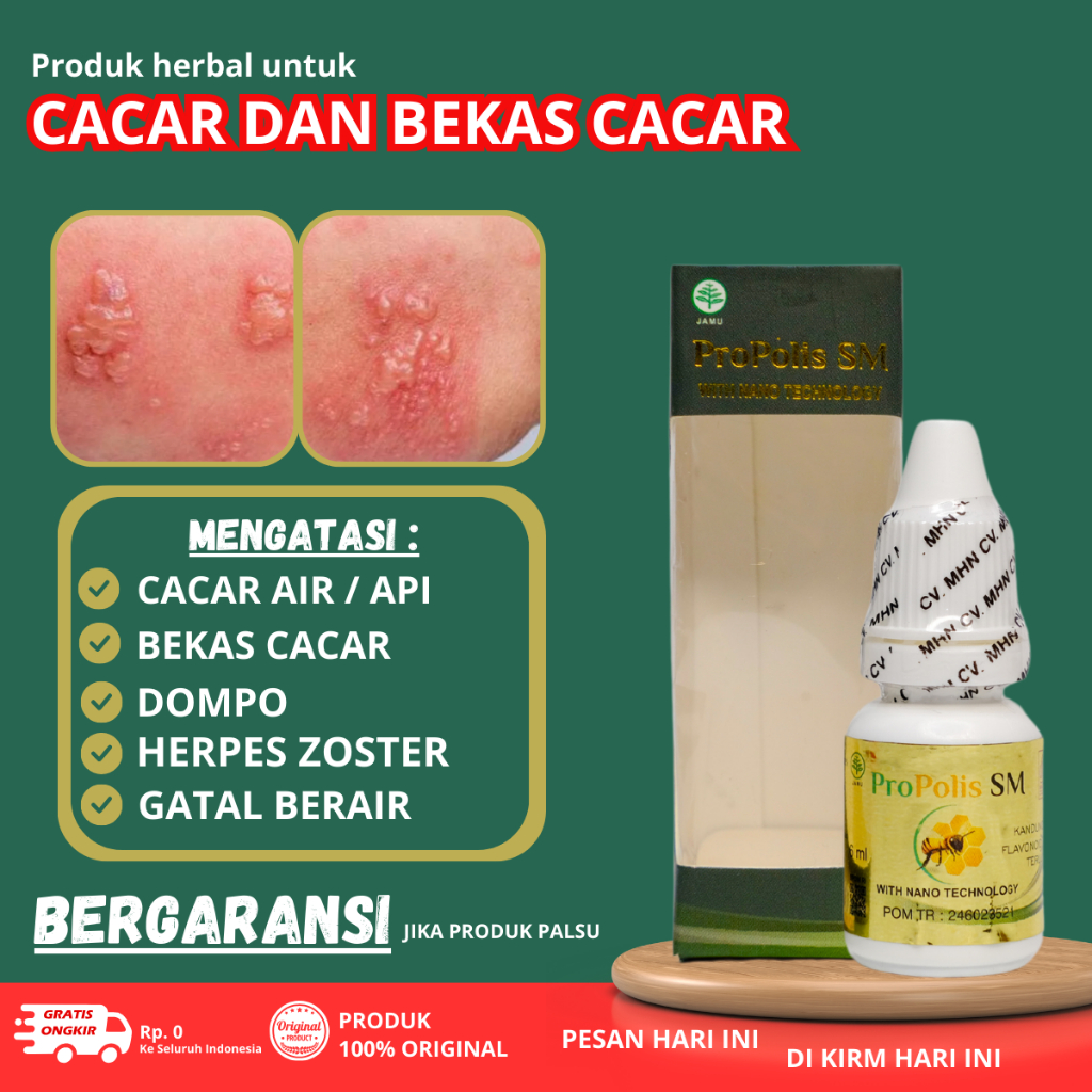 Obat Penghilang bekas cacar - Salep cacar api / ular - Obat Campak Anak dan Dewasa - Obat herpes zos