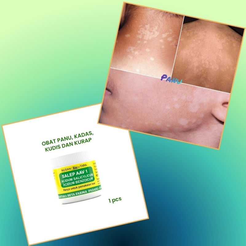 Obat Ampuh Penghilang Panu Kadas Kudis & Kurap