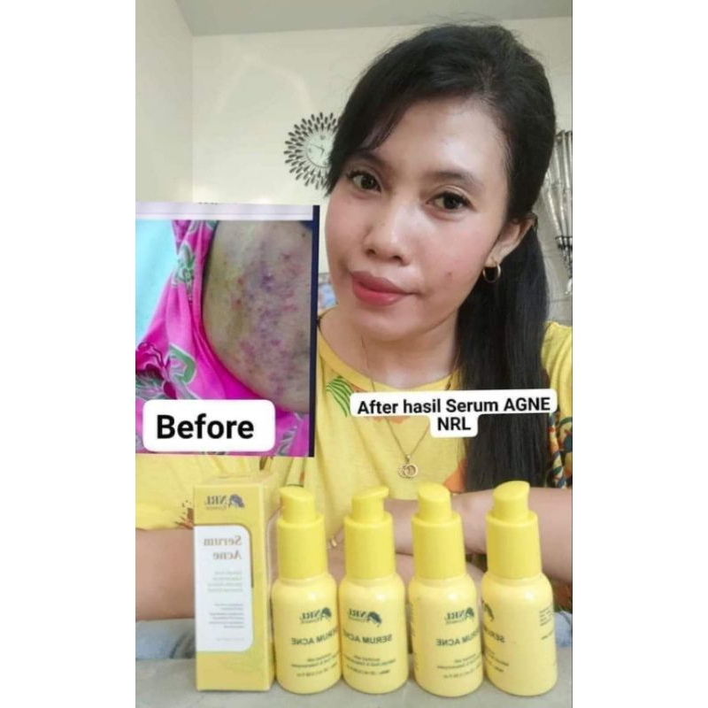 SERUM ACNE NRL