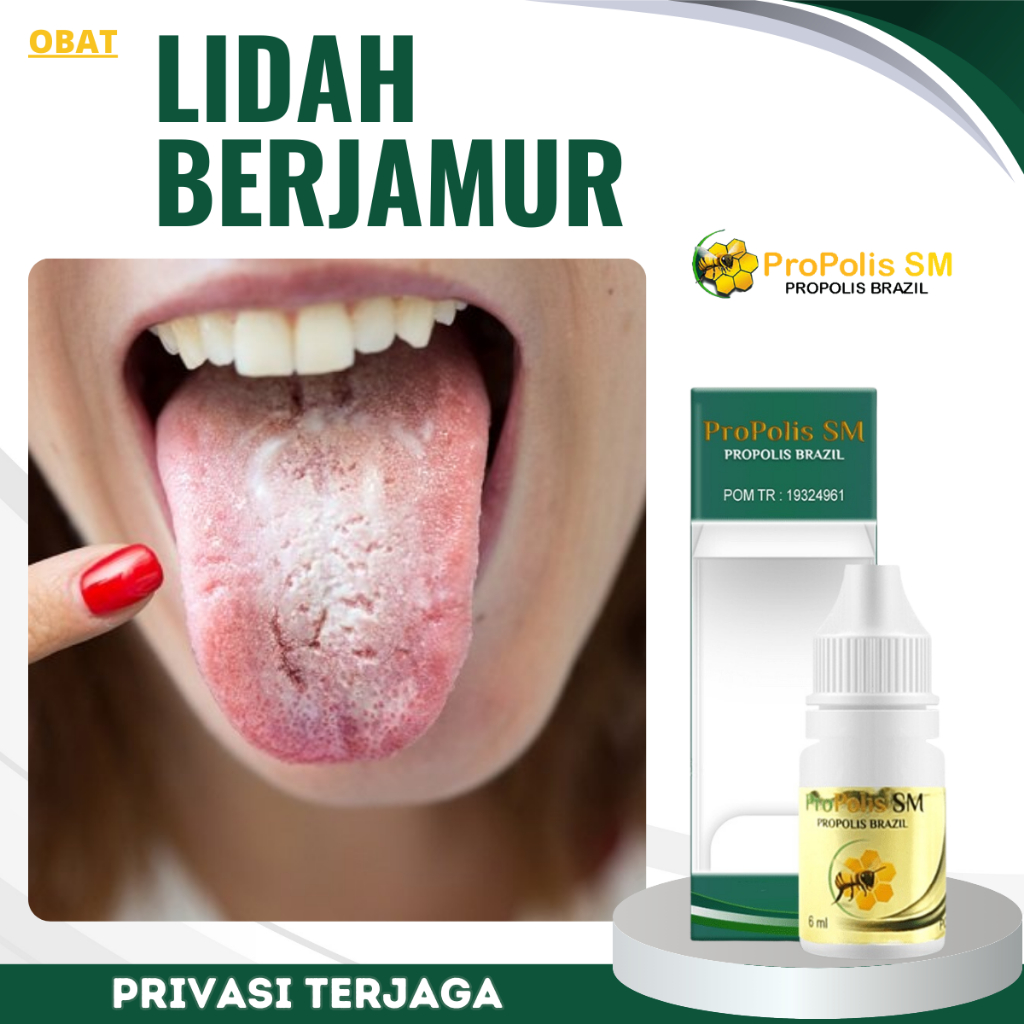 Obat Lidah Berjamur, Obat Kandidiasis, Obat Lidah Mati Rasa, Obat Lidah Pecah Pecah, Obat Lidah Puti