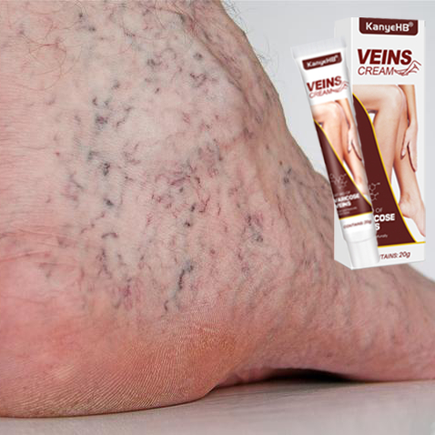 Obat Varises Paling Ampuh Vaskulitis Flebitis Pengobatan Vaskulitis Salep Obat Varises Di Kaki Dan B