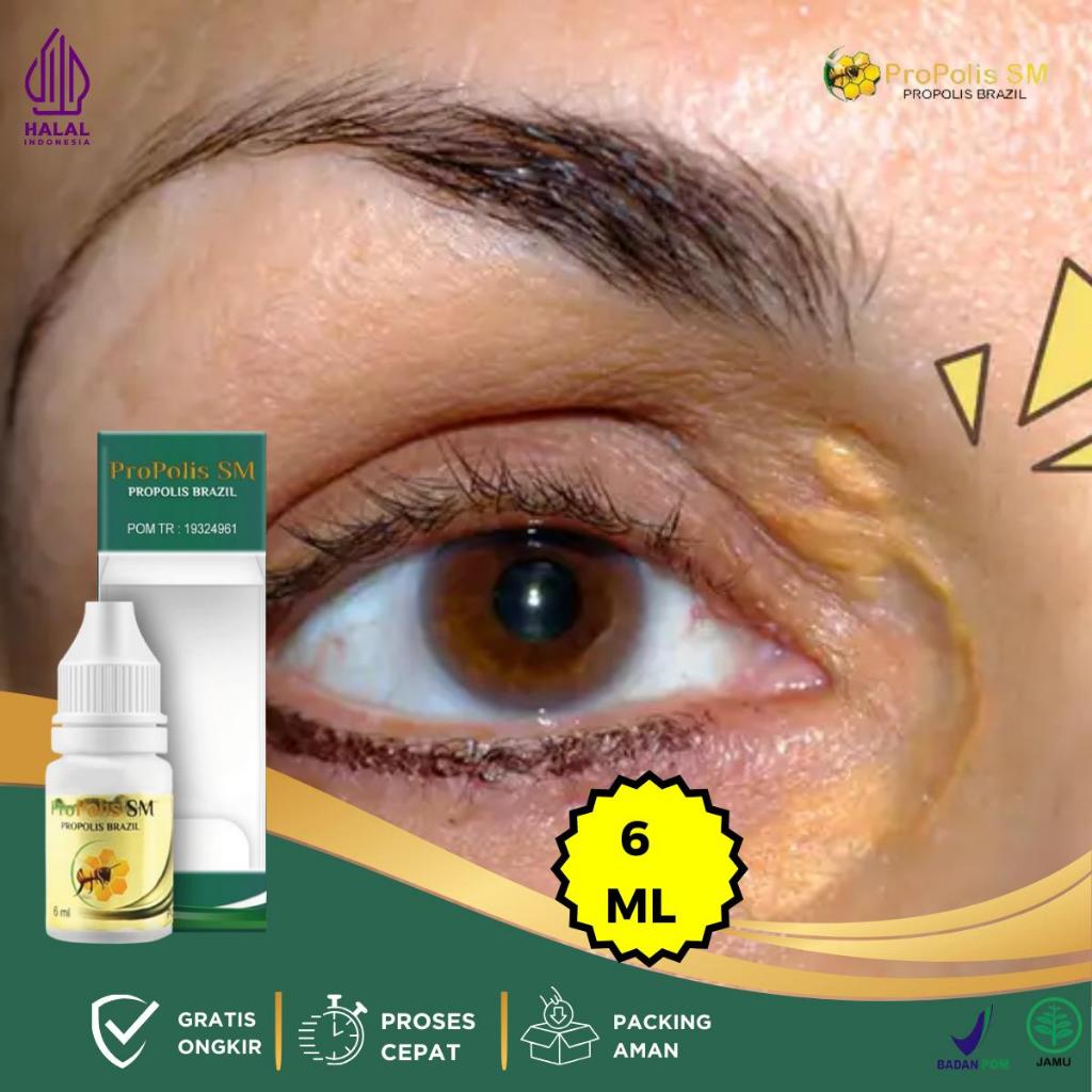 Obat Xanthelasma, Obat Gumpalan Lemak DiKelopak Mata, Obat Flek Kuning Dikelopak Mata, Obat Penghila