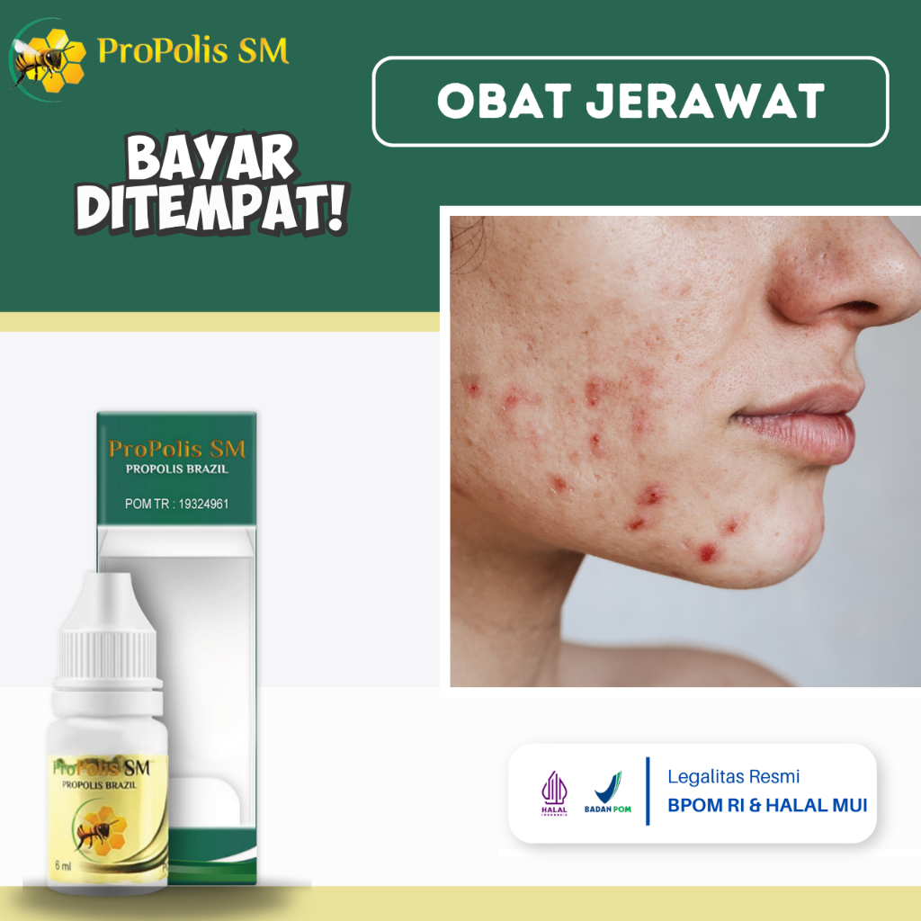 Obat Jerawat, Obat Pengempis Jerawat, Obat Bekas Jerawat, Jerawat Batu, Obat Jerawat Bernanah, Obat 