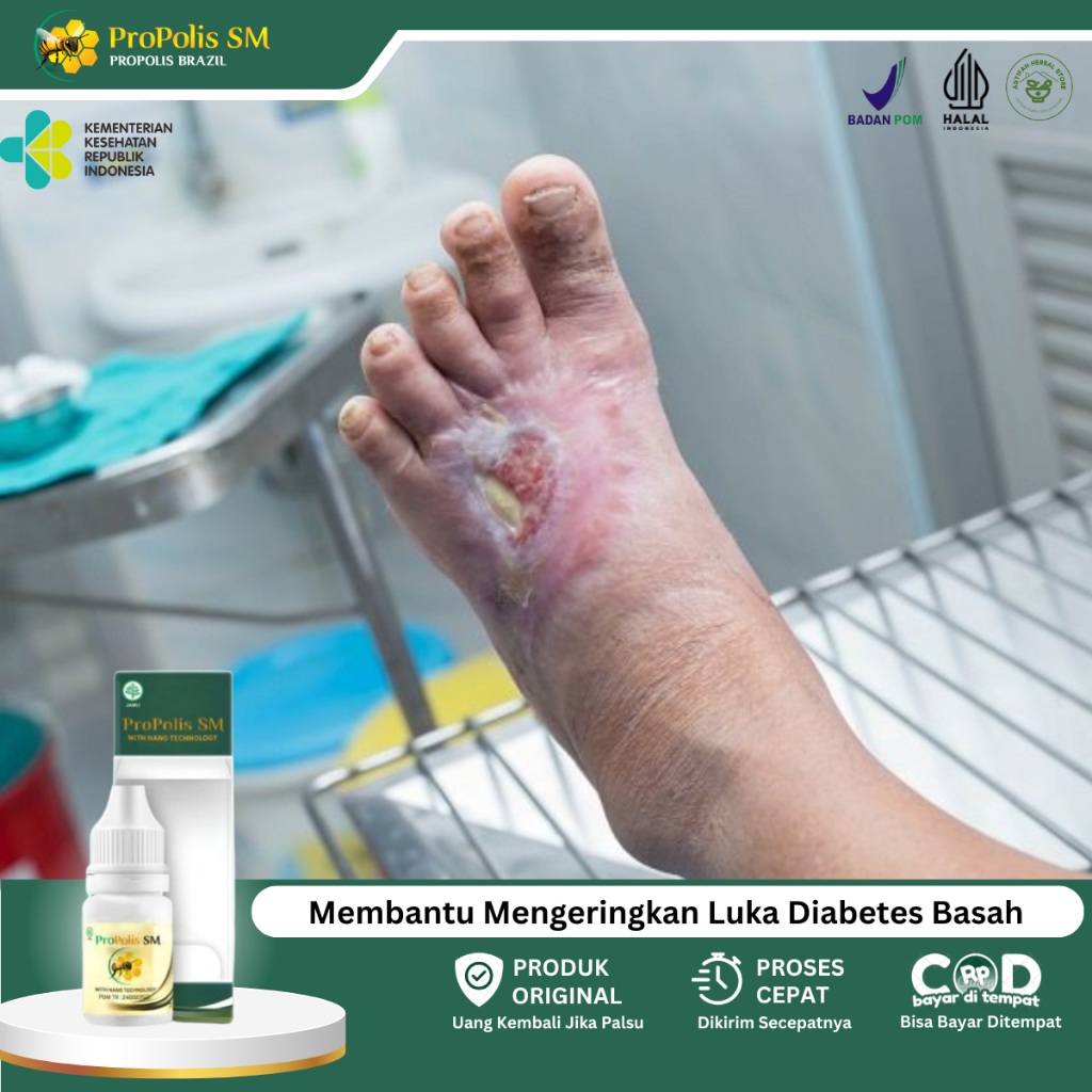 Obat Luka Diabetes Basah, Obat Luka Infeksi, Obat Luka Diabetes Kering, Obat Luka Basah Bernanah, Ob