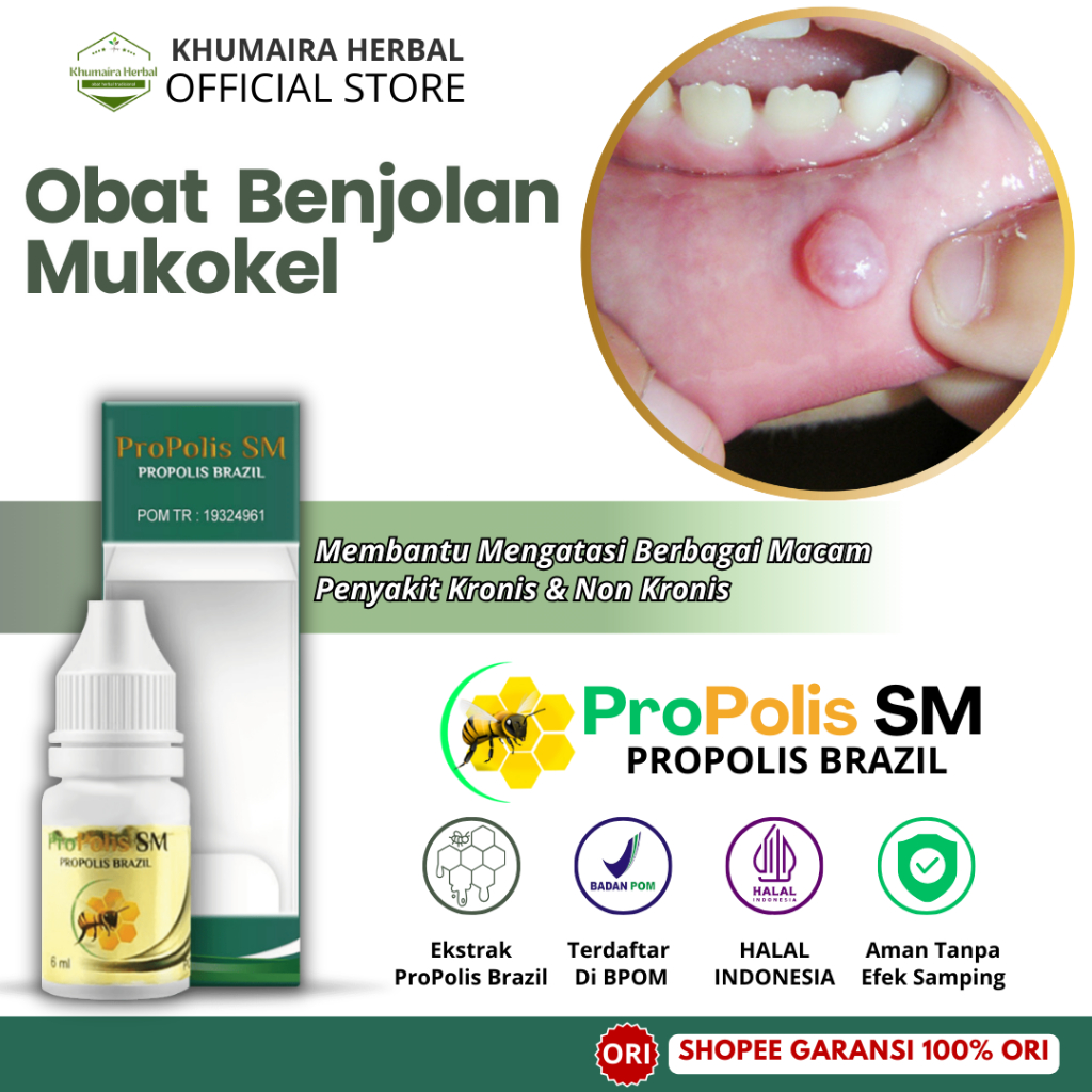 Obat Benjolan Mukokel, Obat Benjolan di Bibir, Benjolan Di Mulut, Benjolan Di Lidah, Kista Mukokel, 