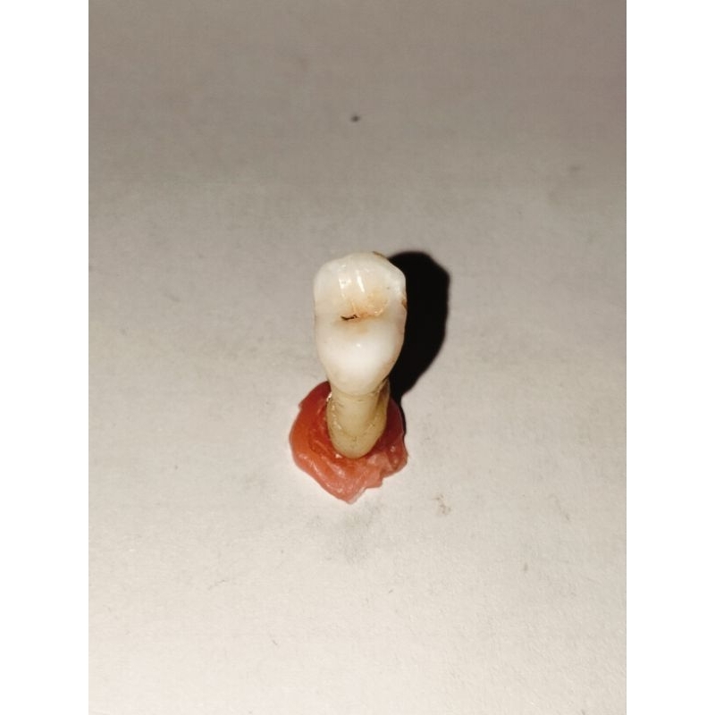 Gigi asli premolar 15