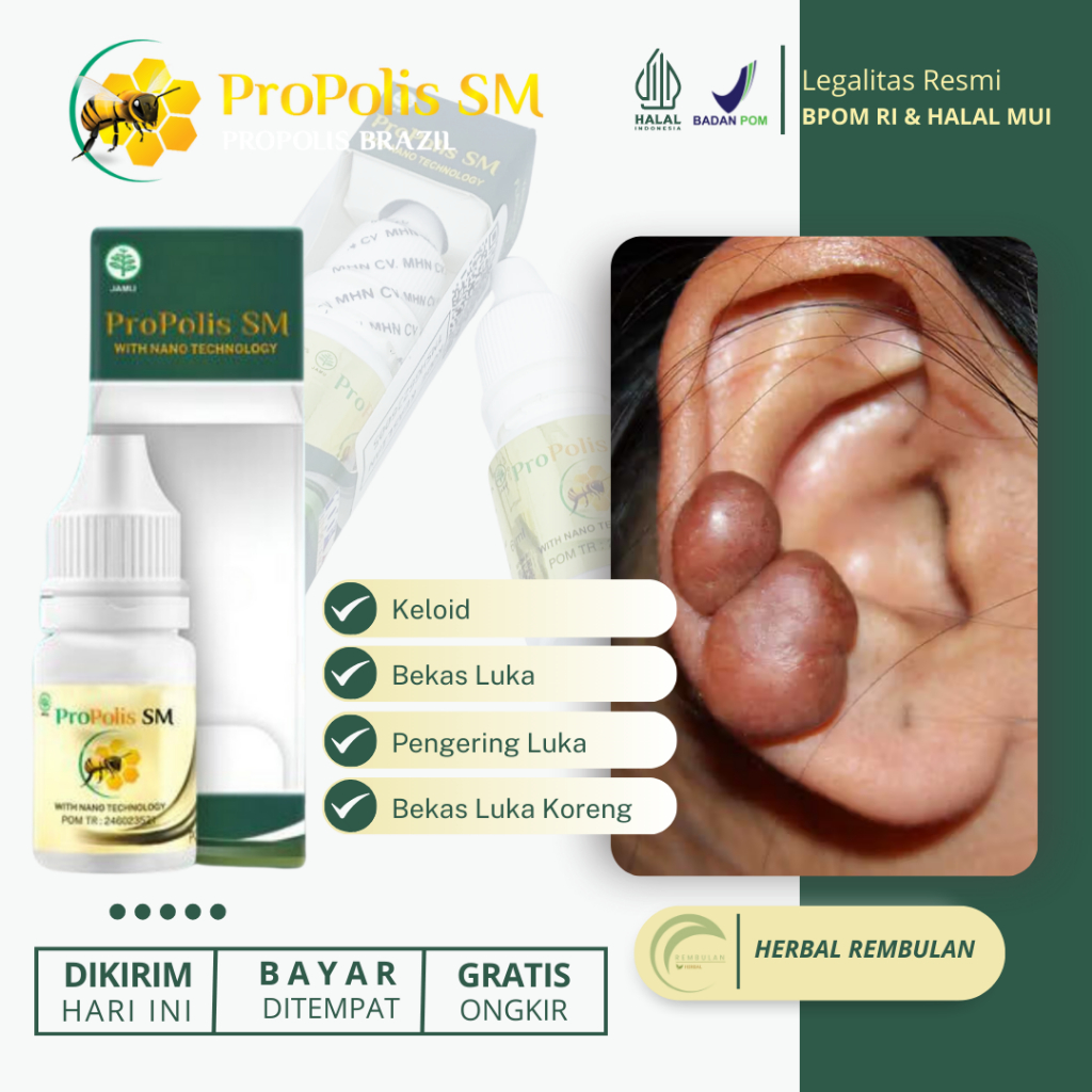 Obat Keloid Bekas Luka Operasi Caesar Sesar Tindik Injeksi Daging Jadi Keloid Menahun Bekas Luka Lam