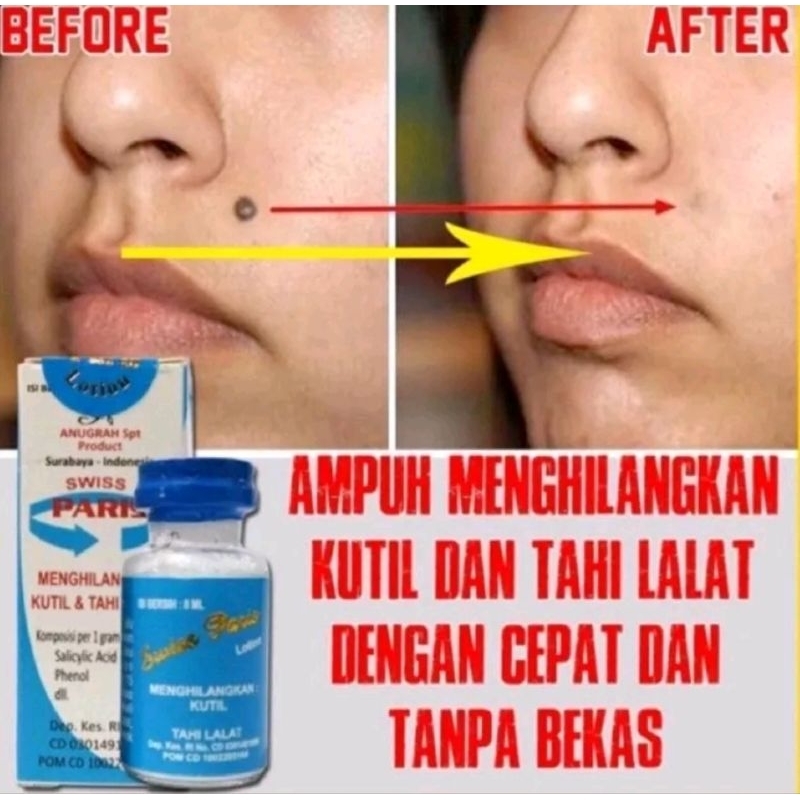swiss paris lotion salep / krim kutil & tahi lalat