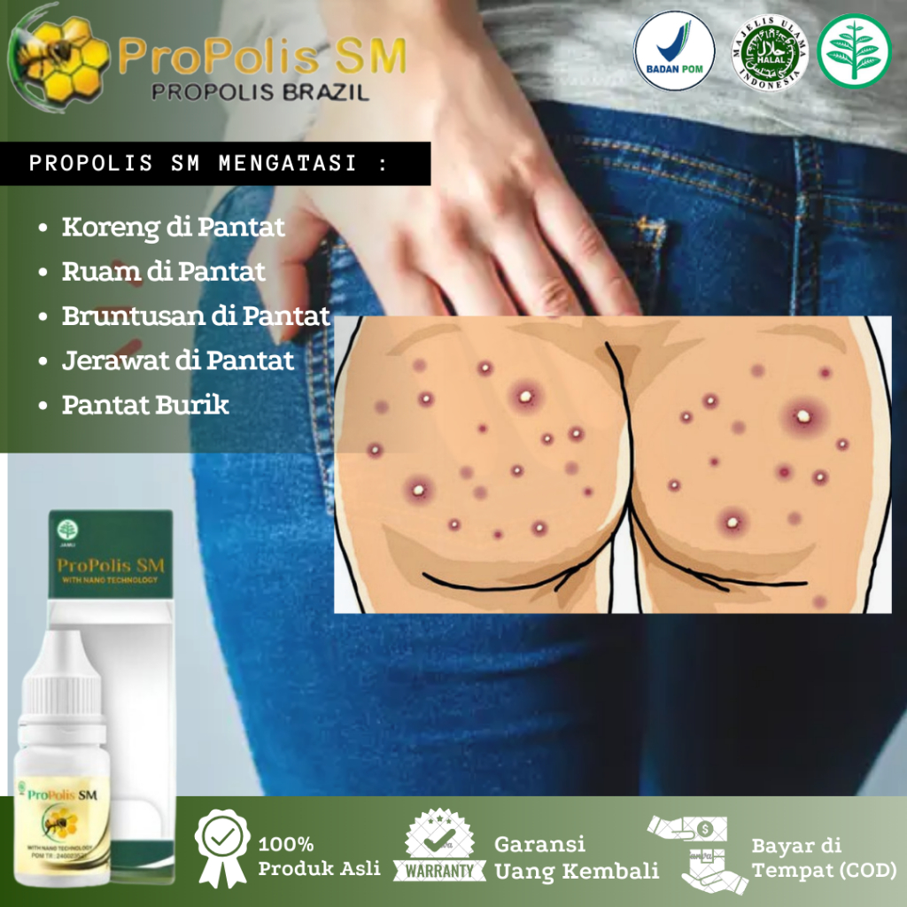 Propolis SM Obat Koreng di Pantat, Gatal Ruam di Pantat, Bekas Luka Hitam di Pantat, Gatal Pantat Ak