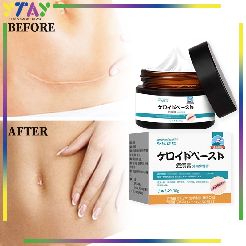 Cream Penghilang Bekas Luka Hilangin Bekas Luka Korengan Krim Menghilangkan Bekas Luka Pehilang Beka