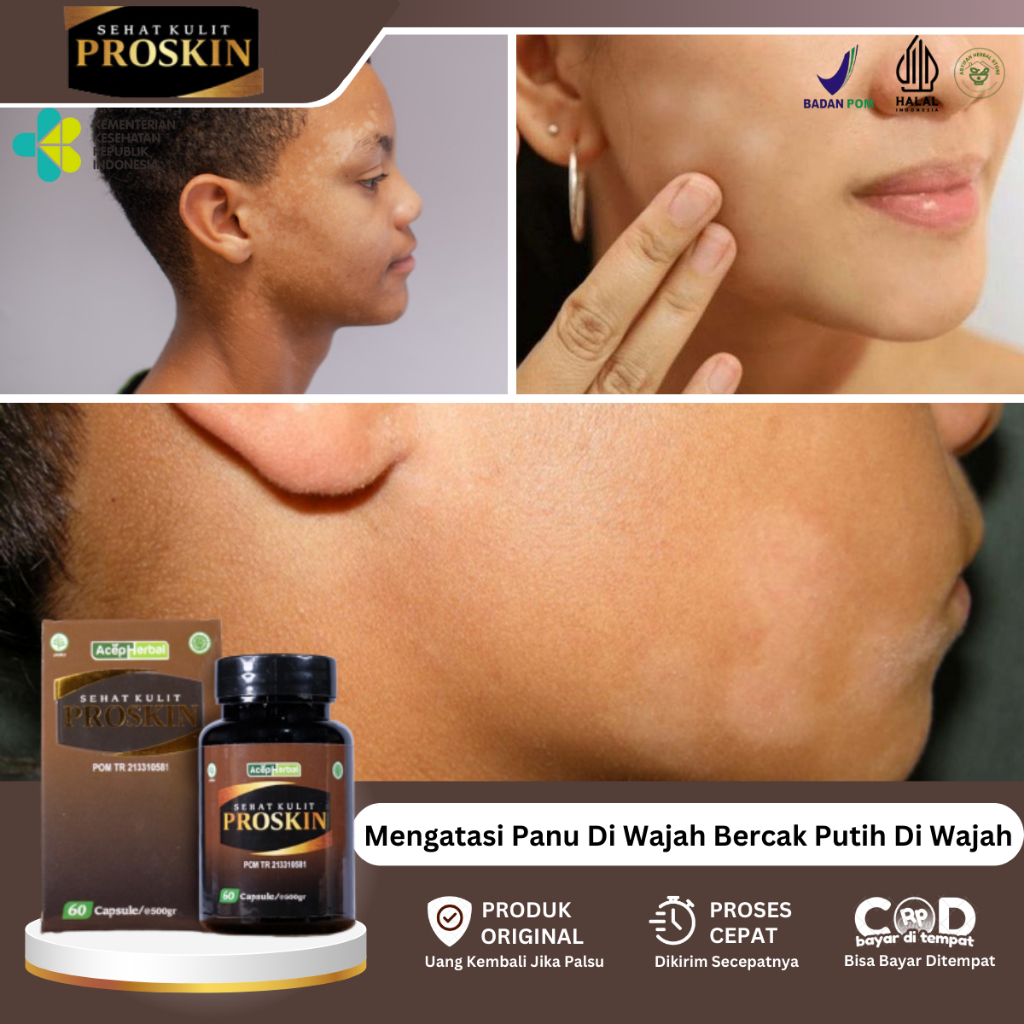 Obat Panu Di Wajah, Obat Penghilang Panu, Obat Jamur Kulit, Obat Kulit Panuan, Obat Panu Di Wajah, O