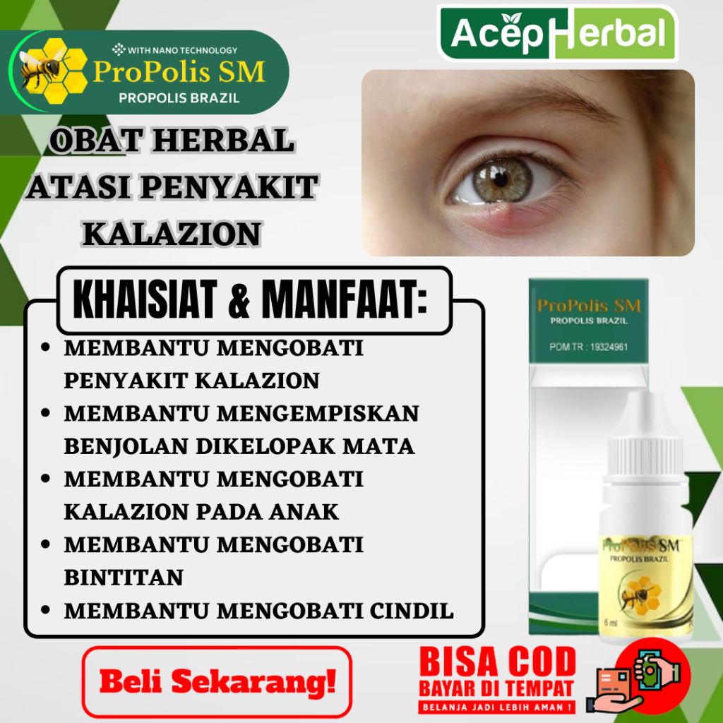 Obat Kalazion - MENGEMPESKAN BENJOLAN DI KELOPAK MATA - Obat Kalazion Anak, Obat Kalazion Dewasa Oba