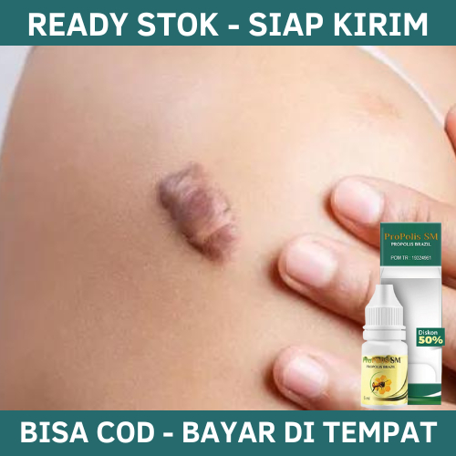 Obat Keloid, Obat Untuk Keloid, Obat Keloid Daging Tumbuh, Obat Keloid Menahun, Obat Hilangkan Keloi