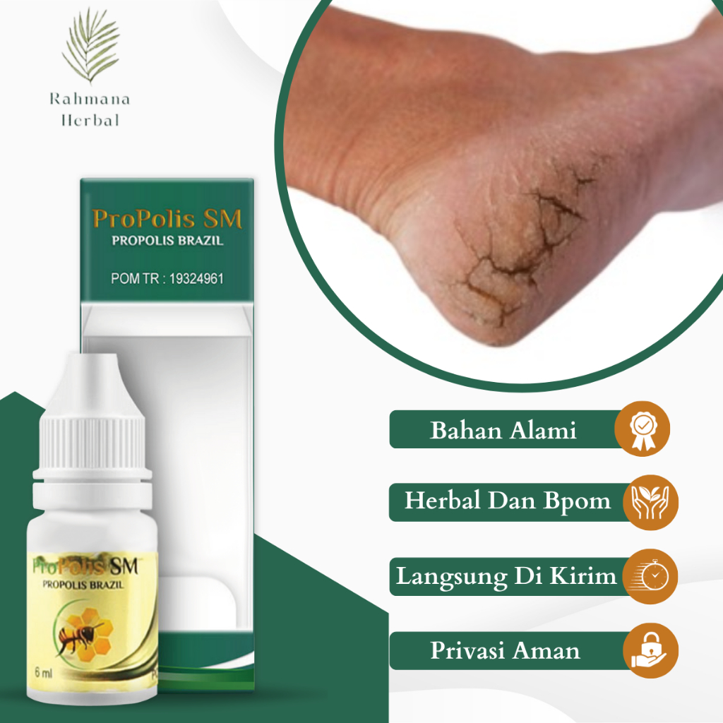 Obat Kaki pecah pecah Tumit Kaki Kering Rorombeheun Salep Tumit Kasar Obat Tumit Pecah Dan Kering Ka