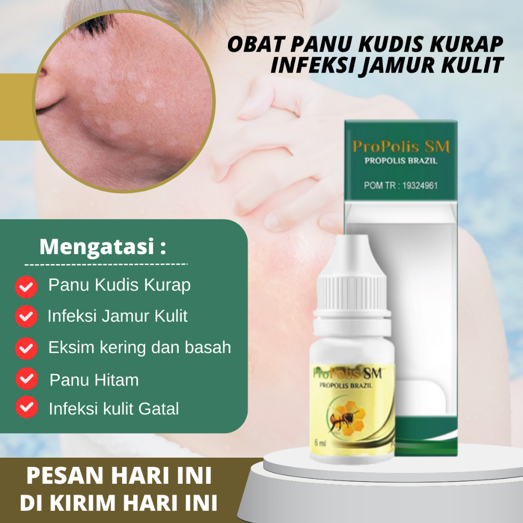 Penghilang Jamur Panu, Obat Panu Gatal, Obat Infeksi Jamur Panu Kurap, Salep jamur Kulit, Obat Kulit