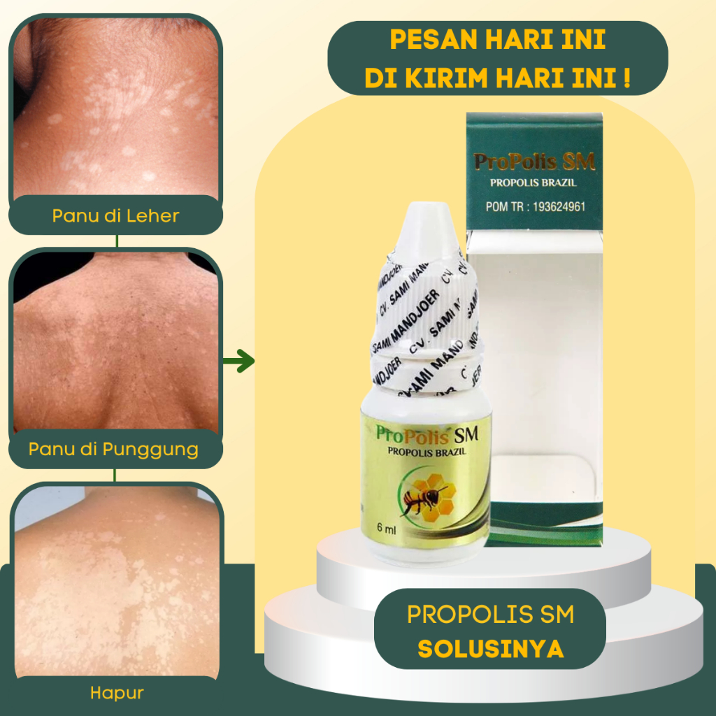 Obat Gatal Kulit, Jamur Kulit, Obat Gatal Jamur Kulit, obat gatal kulit paling Banyak di Cari, Obat 