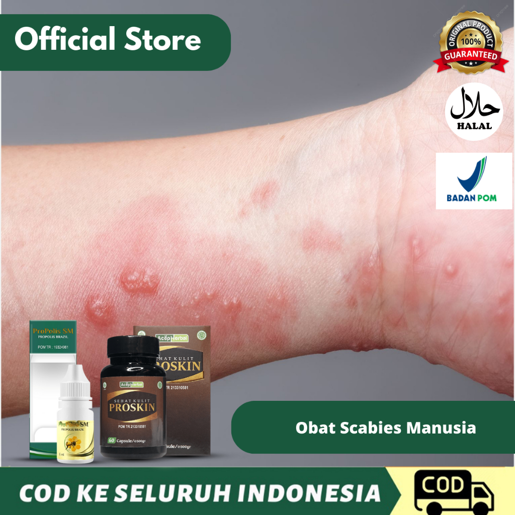 Obat Scabies, Obat Scabies Manusia, Salep Scabies untuk manusia, Obat Scabies Kudis kurap , Salep ku