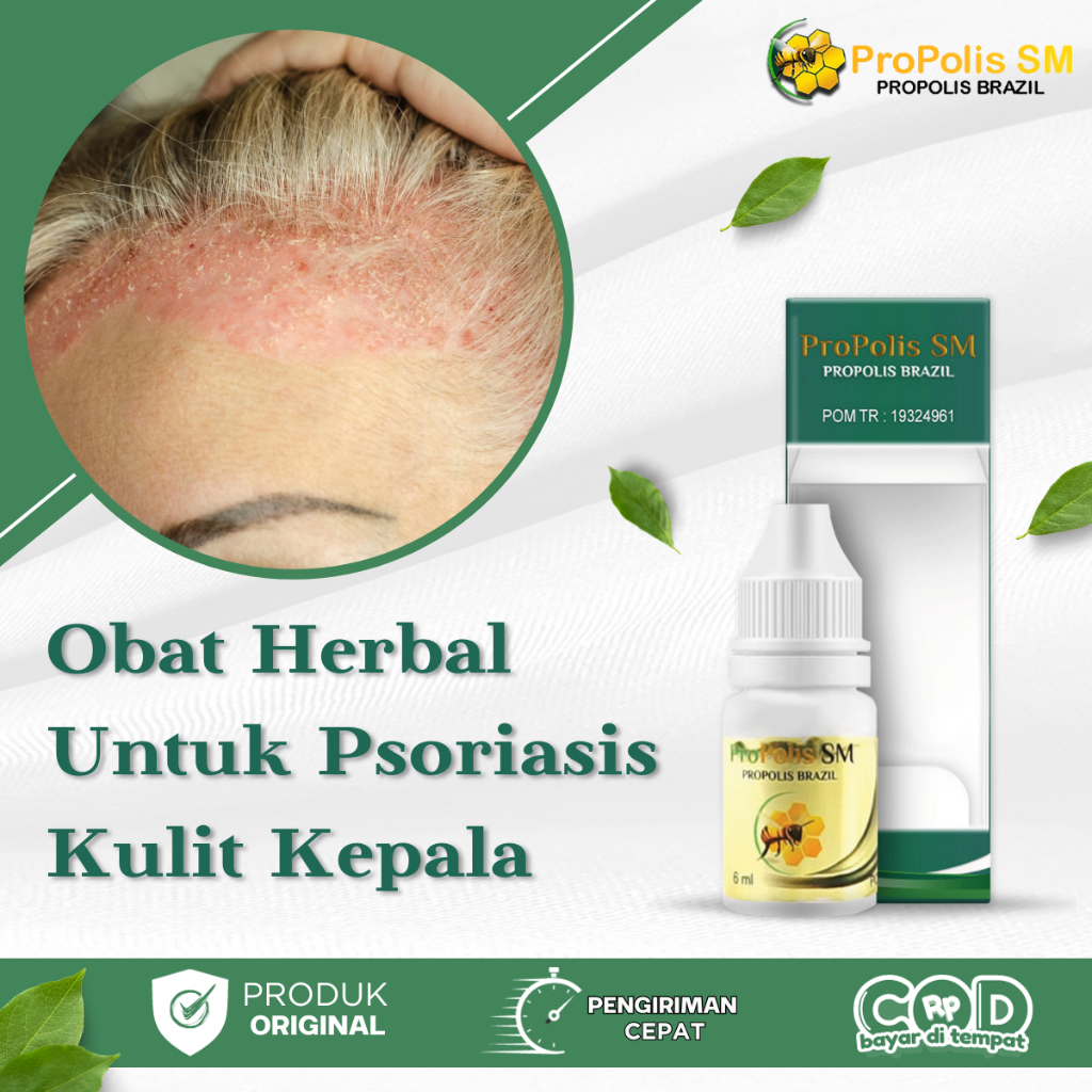 Obat Psoriasis Kulit Kepala, Jamur Kulit Kepala, Kulit Kepala Bersisik, Infeksi Jamur di Kulit Kepal