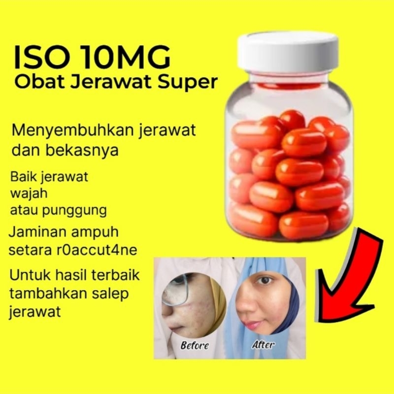 Obat Jerawat Ampuh Original, Suplemen Jerawat Hormonal Bekas Jerawat