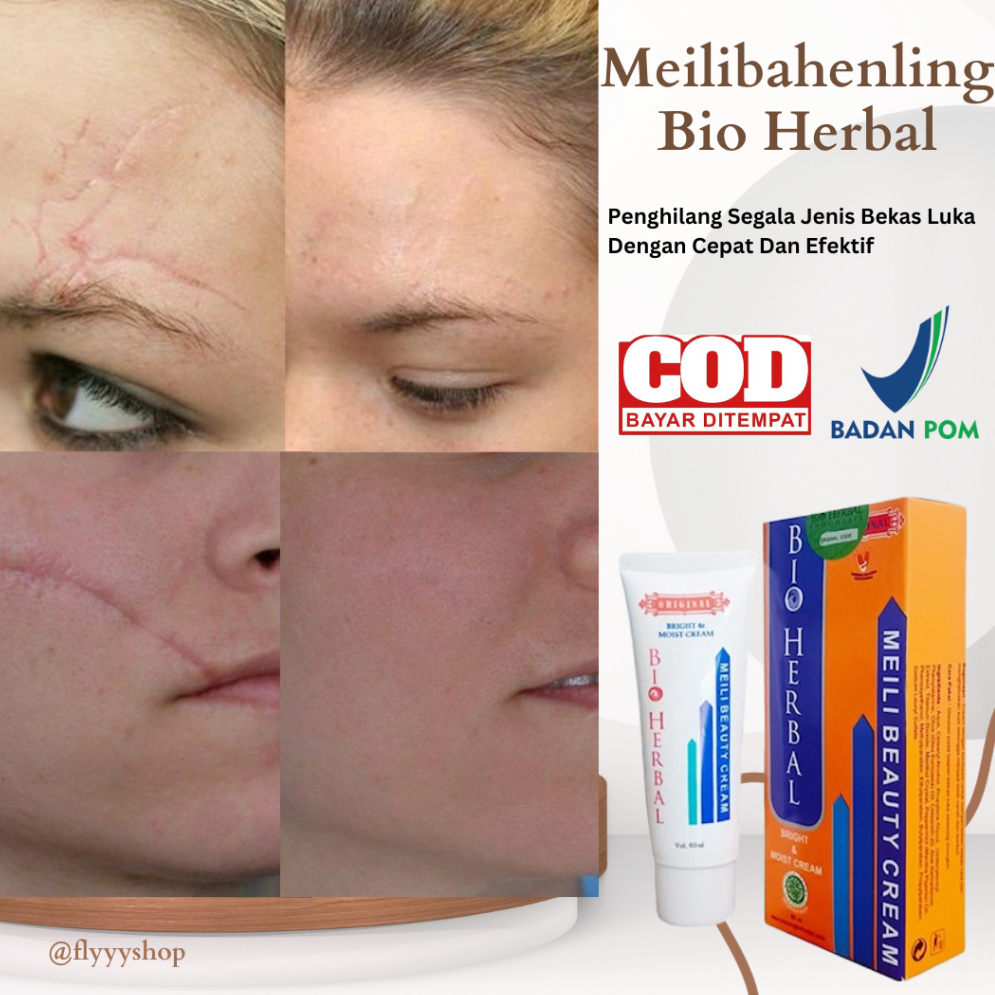 Cream Penghilang Bekas Luka Jerawat Keloid