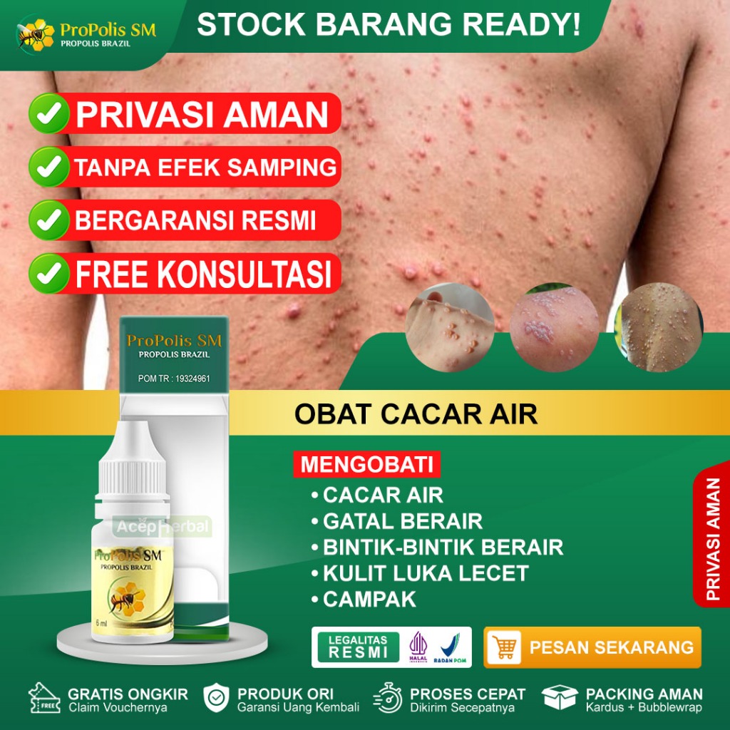 Obat Cacar Air Gatal-gatal Berair Bintik-bintik Berair Kulit Luka Lecet Campak Anak dan Dewasa Propo