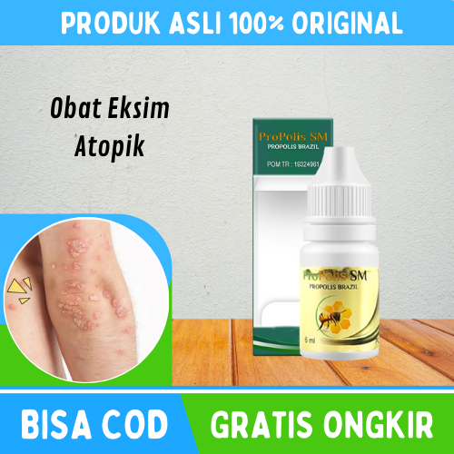 Obat Eksim Atopik, Obat Dermatitis Atopik, Obat Eksim, Obat Eksim Kering, Obat Eksim Kulit, Obat Eks