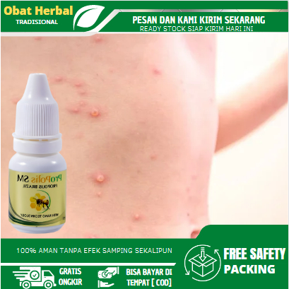 Obat Bintik Bernanah, Obat Penyakit Kulit, Obat Infeksi Kulit, Gatal Bintik Berair, Gatal Berair Dan