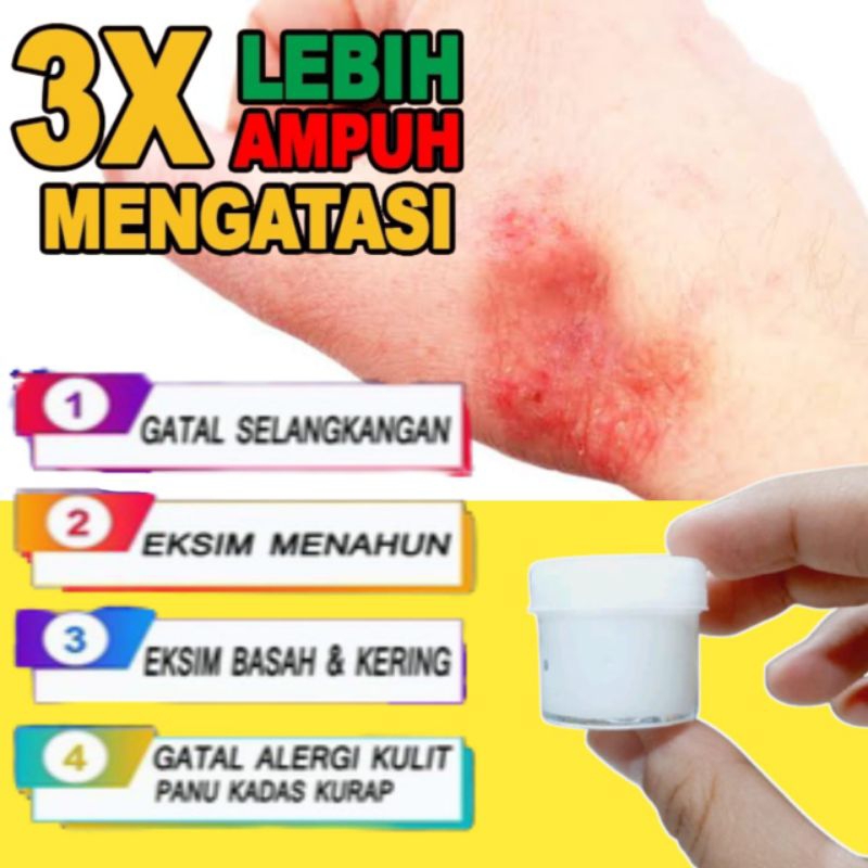 SALEP gatal gatal pada kulit racikan apotek paling ampuh