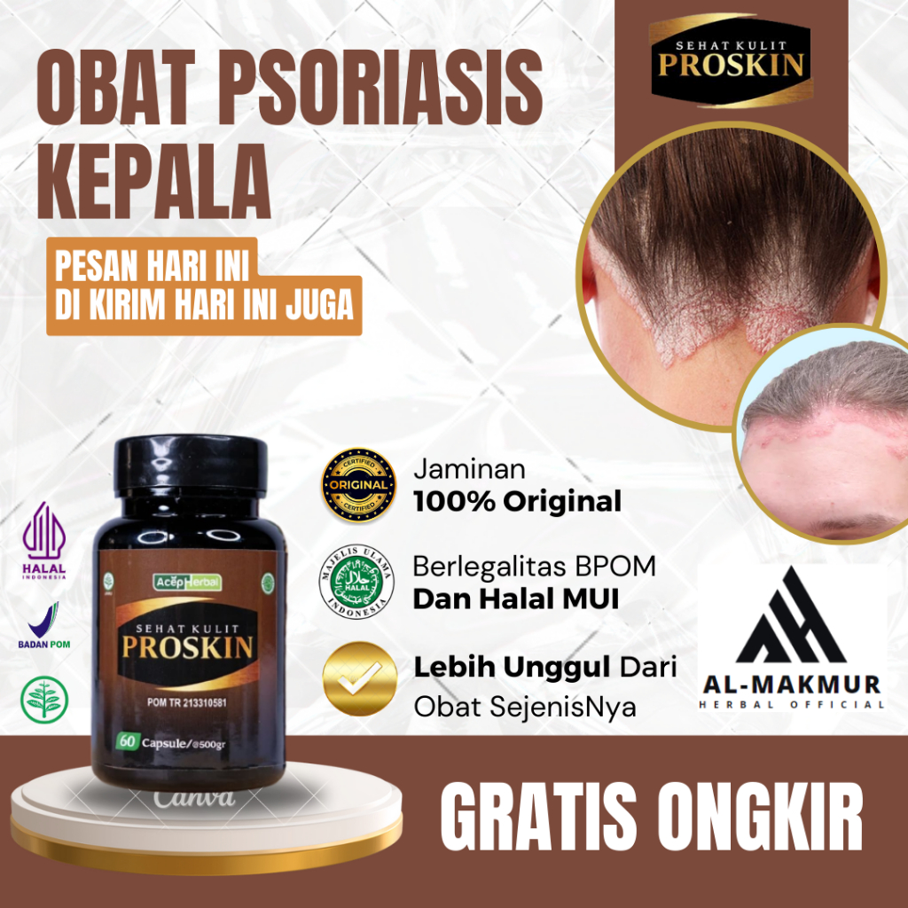 Obat Psoriasis di Kepala, Obat Penyakit Kulit Psoriasis, Obat Kulit Kepala Koreng, Obat Jamur kulit 