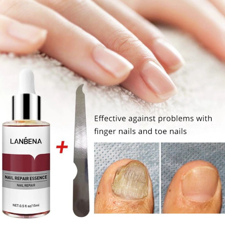 LANBENA Nail Repair Essence Serum Perawatan Jamur Kuku Lanbena Nail
