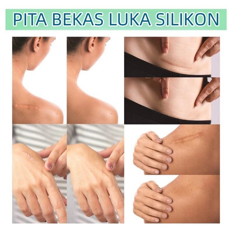 Silicone Scar Sheet 4cm x 1.5m plester Scar Removal Silicone Tape Penghilang bekas luka keloid penghilang strechmark