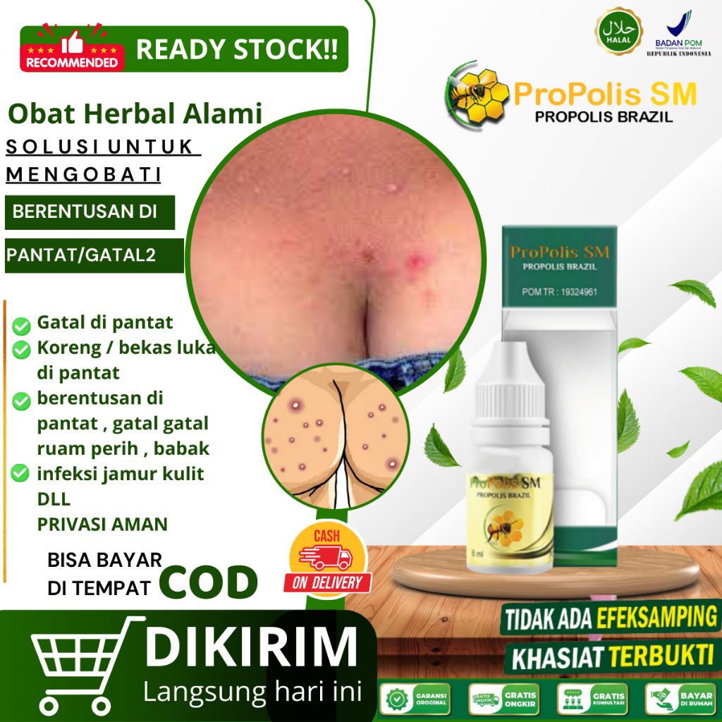 Obat Gatal Pantat, Obat Pantat Burik, Obat Herbal Gatal Pantat,Gatal Pantat & Selangkangan,Gatal Di 